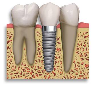 implantes_dentários.jpg